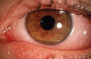 allergy1