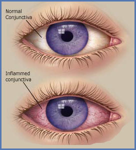 conjunctivitis2
