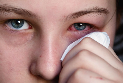 Viral conjunctivitis